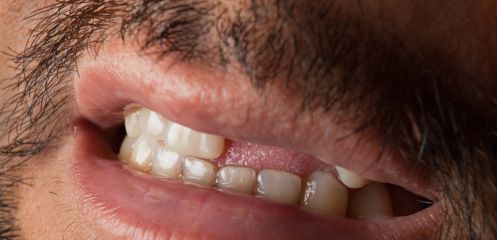 Full upper or lower tooth loss